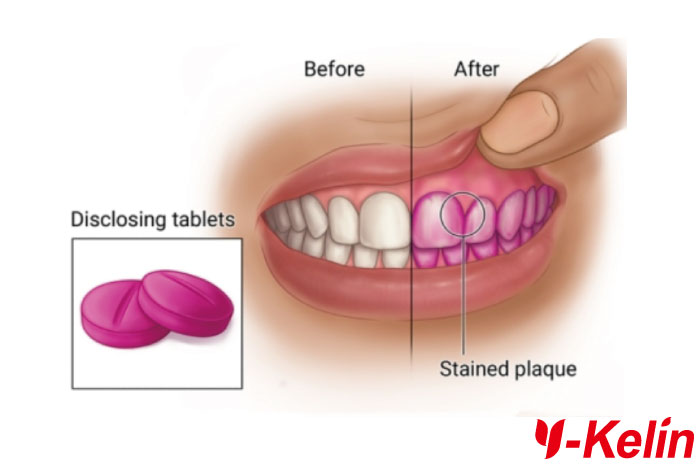 Dental Plaque Disclosing Tablets for Oral Health